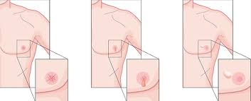 Many males with breast cancer have inherited a brca mutation, but there are other causes, including alcohol use disorder and exposure to certain hormones and ionizing radiation. What About Breast Cancer In Men The Daily Courier Prescott Az
