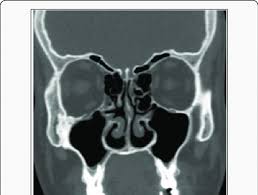 Shows The Anterior Ethmoid Arteries Passing Within The Anterior Ethmoid Download Scientific Diagram