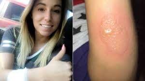 A brown recluse spider bite diagnosis in an area outside their range does not mean that brown recluse the dark spot on the cephalothorax looks a bit like a violin, but do not be fooled. Michigan Woman Treated For Brown Recluse Spider Bite Cbs News