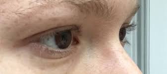 Mon dessin numéro 2 était comme ça: Oeil Enfonce Et Paupiere Tombante Blepharoplastie Forum Estheticon Fr