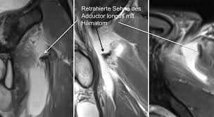 Pulled hamstring in a handballer. Muskel Sehnen Verletzungen Sportarztezeitung