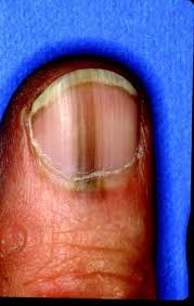 Image result for Acral lentiginous melanoma nail
