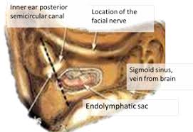 Image result for Inner Ear Decompression Sickness