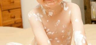 مرض الجدري موضوع