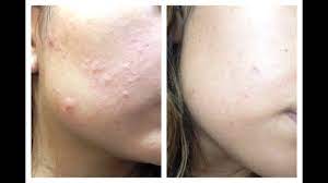 Como Eliminar El Acne En Tu Rostro En Una Semana Tratamiento Contra Granitos Acne Hormonal Youtube