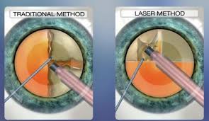 Image result for Cataract Extraction