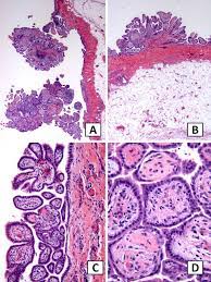 Approximately 35% of all mesotheliomas arise only from the peritoneum. Well Differentiated Papillary Mesothelioma Manifesting In A Hernia Sac Sciencedirect