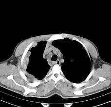 Clinical oncology is affiliated with the association for radiation research. Malignant Mesothelioma Of The Pleura Diffuse Irregular And Nodular Download Scientific Diagram