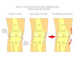 A direct blow to the knee or a noncontact injury due to cutting or sudden deceleration or stopping may damage the mcl. Collateral Ligament Injuries Chris Bailey Orthopaedics