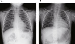 Image result for Transfusion Associated Circulatory Overload