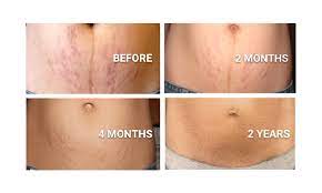 Tretinoin, when it works, helps to rebuild a protein in the skin called collagen, making the stretch marks look more like your normal skin. Stretch Mark Treatment Trilastin