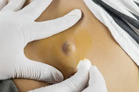 As the follicles become clogged with hair and skin debris, cyst formation occurs. Is This A Cyst