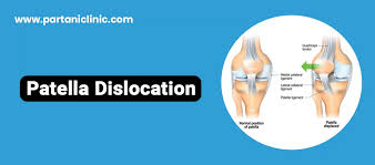Image result for Patellar Dislocation