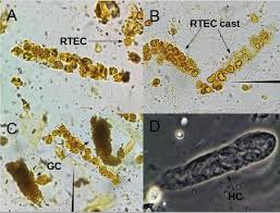 Image result for Urinary Cast