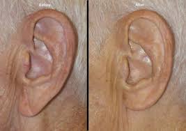 Can you spots the signs? Earlobe Reduction Dr Trey Aquadro Board Certified Surgeon