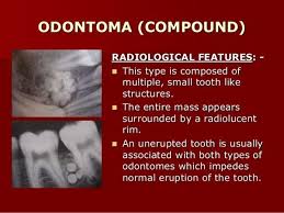 Dentaltown Odontoma Odontoma Also Termed Odontome Is A Benign Tumor Of Odontogenic Origin I E Linked To Tooth Dev Oral Pathology Dentaltown Pharmacology