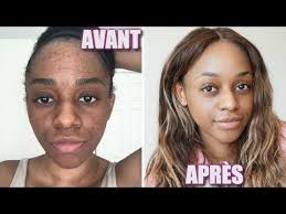 Ma Routine Soins De La Peau Teint Lumineux Anti Boutons Anti Taches Anti Cernes Maggy Kloset Youtube Tache Peau Anti Tache Visage Tache Visage