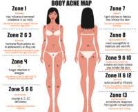 What Your Acne Map Is Telling You The Chalkboard