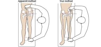 Image result for Functional Leg Length Discrepancy
