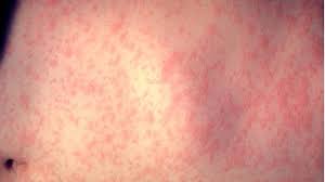 Phoenix-area theatergoers exposed to measles. What to know