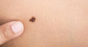 Melanoma can sometimes come back. Racgp Australian Researchers Develop World First Blood Test To Detect Melanoma Early