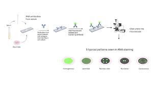 Image result for ANA Staining Pattern