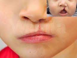 Kondisi seperti ini biasanya menimbulkan gejala lain seperti sariawan, rasa nyeri pada mulut, dan lain sebagainya. Bayi Sumbing Ada Satu Nasihat Peribadi Daripada Doktor Ini Yang Mak Ayah Patut Buat Mingguan Wanita