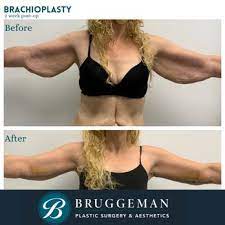 · i had coolsculpting done on my neck. Bruggeman Plastic Surgery Aesthetics 96 Photos Updated Plastic Surgeons 14155 N 83rd Ave Peoria Az Phone Number Yelp
