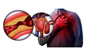 O enfarte agudo do miocárdio, ou ataque cardíaco, ocorre quando uma das artérias do coração fica obstruída, o que faz com que uma parte do músculo cardíaco fique em sofrimento por falta de oxigénio e nutrientes. Infarto Sintomas Em Mulheres Prevencao Fator De Risco