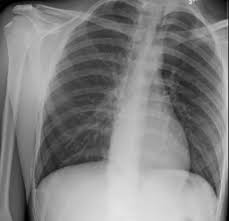 Prompt diagnosis and treatment of a pneumothorax is essential. Spontaneous Pneumothorax Jetem