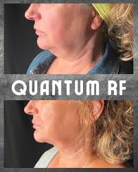 ✨ Introducing our NEW facials, designed to target your unique skin concerns  and deliver stunning results! Whether you're dealing with acne, fine lines,  or dullness, our luxurious treatments are tailored to rejuvenate