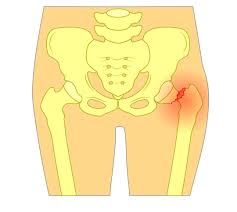 Reportage de luc gélinas alors que la lnh en est à une deuxième journée de pause en réaction au racisme et à la brutalité policière. Fracture Du Col Du Femur Signes Operation Reeducation