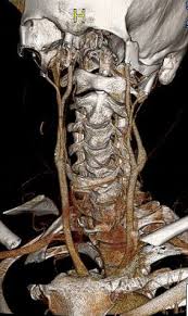 Dolor de cabeza que generalmente empieza en la base del cráneo. Cervical Vertigo