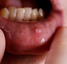 Image result for gum cancer symptoms