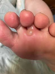 Image result for pompholyx soles of feet