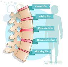 Can Stem Cells Help Reverse Degenerative Disc Disease
