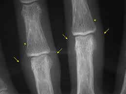 Image result for XRay Changes in Rheumatic Conditions