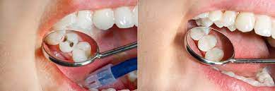 Average Cost Of Tooth Filling How Much Tooth Filing Cost In Los Angeles