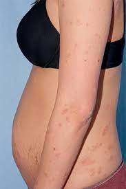 Pata întunecată în câmpul vizual; Eruptii Cutanate In Timpul Sarcinii Patuturi Pentru Bebelusi