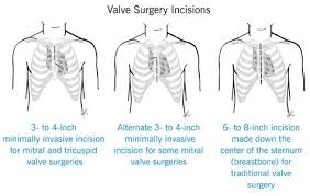 Minimally Invasive Heart Surgery Heart Surgery Surgery Heart Care