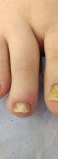 Image result for Onycholysis feet