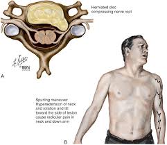 Image result for Spurling Sign