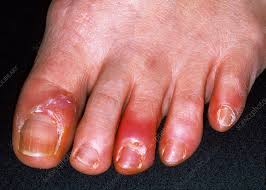 Image result for Paronychia feet