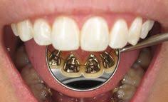 This hides them from view, making them difficult to see by others. 11 Best Lingual Braces Ideas Lingual Braces Braces Braces Smile