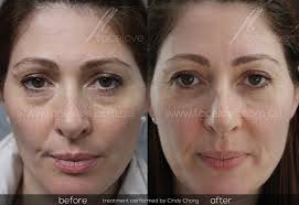 Under eye filler before and after. Tear Trough Filler Facelove