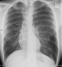 The pleura is pushed further away from the chest wall, and the pneumothorax is usually a lot … 27 M Mit Plotzlich Einsetzenden Thorakalen Schmerzen Dyspnoe Und Hamoptysen Springerlink