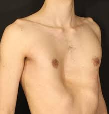 Image result for Pectus Excavatum