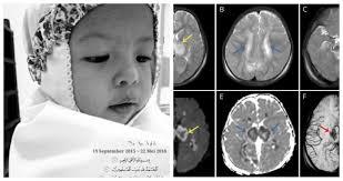 Selain meningitis, simptom utama gbs adalah gangguan pernafasan dan kuman dalam darah (sepsis). Masuk Icu Baru Tahu Ada Jangkitan Kuman Nampak Aktif Ibu Ini Kongsi Kisah Hilang Cahaya Mata Menjelang Syawal