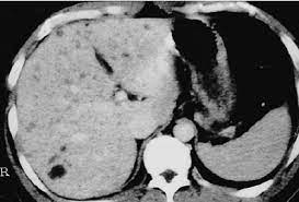 Enhanced Ct Scan Reveals Multiple Irregular Hypodense Nodules In Both Download Scientific Diagram