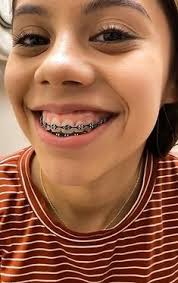 Private orthodontic treatment is widely available, but expensive. Adult Braces